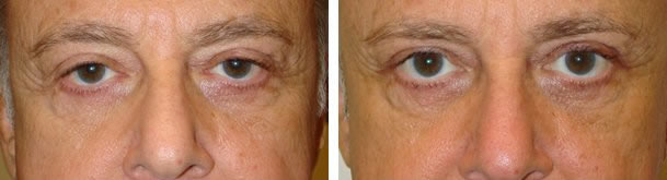 Before (left) and 6 months after (right) upper blepharoplasty, ptosis surgery, brow contouring.