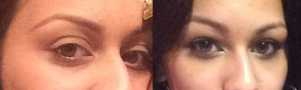 29 year old female, with relatively bulging eyes (large eyes) and surrounding hollowness around the eyes, underwent cosmetic orbital decompression (fat and some behind eyeball removed to allow the eyeball to sink back) and fat injection in upper and lower eyelids, to give more youthFUL eye appearance. Preop and 3 months postoperative photos are shown.