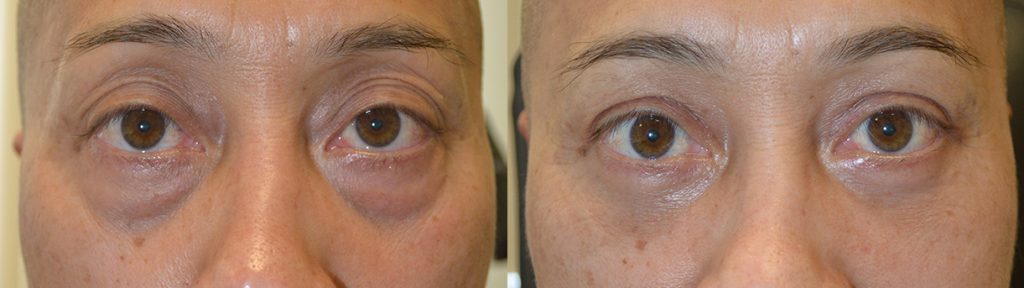 57 year old male, looking tired and older, underwent eye plastic surgery: upper blepharoplasty + lower blepharoplasty (transconjunctival with fat bags redraping and skin pinch), under local anesthesia with oral sedation in the office. Before and 3 months after cosmetic eyelid surgery procedures photos are shown.