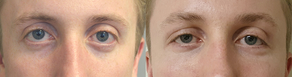 27 year old male, with inherited lower eyelid retraction with sclera show (white under colored eye area), underwent lower eyelid retraction surgery (internal scar-less approach with midface lift, eyelid spacer graft) and orbital rim tear trough implant, to give more almond shape eyes and reduce scleral show. Before and 3 months postoperative photos after cosmetic eyelid surgery are shown.