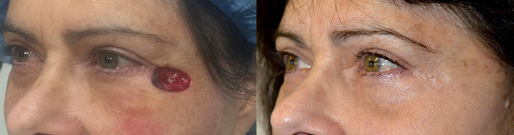 57 year old female, with right eyelid/temple skin cancer (basal cell carcinoma) Mohs defect underwent reconstructive eyelid surgery. Before and 3 months postoperative photos are shown.