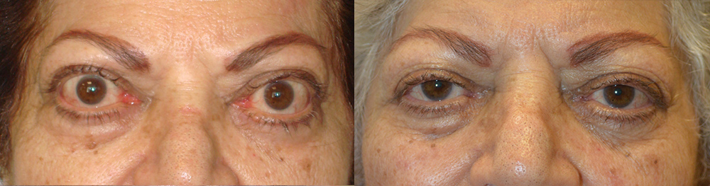 75 year old female, with Graves thyroid eye disease with bulging eyes (proptosis) underwent orbital decompression surgery to restore eye position and allow better eye closure. Before and 4 months postoperative photos are shown.