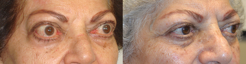 75 year old female, with Graves thyroid eye disease with bulging eyes (proptosis) underwent orbital decompression surgery to restore eye position and allow better eye closure. Before and 4 months postoperative photos are shown.