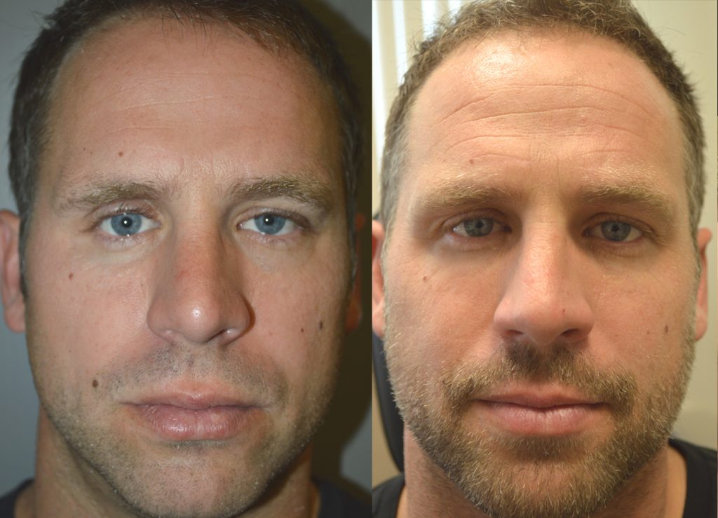 Before (left) 40 year old male, with history of multiple large orbital fractures, with significant enophthalmos (sunken eye) and cheek fracture with sunken cheek. After (right) after right orbital fracture surgery, enophthalmos (sunken eye) surgery with orbital floor implant, and cheek implant.