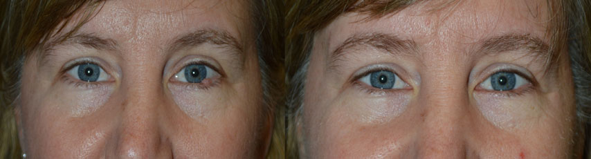 Middle age woman with large benign left lower eyelid lesion at the lash line. The eyelid lesion was excised under local anesthesia in the office, without requiring any stitches. Before and 2 weeks after photos are shown.