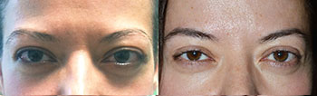 38 year old female, with bulging protruding eyes from Graves disease underwent bilateral orbital decompression surgery (bone and fat removed from behind the eyeball) resulting in eyeball going back), giving more natural eye shape and function. Preoperative and 3 months postoperative photos are shown. (You can listen to this patient share her story by visiting the video of her on the testimonial page.)