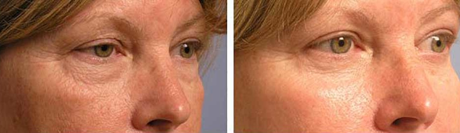 Quad Blepharoplasty Eye Bag Removal in LA