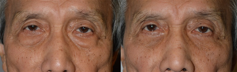 60+ year old Asian male, with eyelid aging, was only concerned about his under eye bags, making him look tired. He underwent transconjunctival lower blepharoplasty with fat repositioning, under local anesthesia in the office. Note the bags are removed, while filling the hollowness below them (tear trough area) at the same time, giving more smooth, youthful under eye area. Before and 3 months after cosmetic eyelid surgery photos are shown.