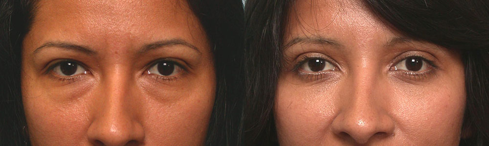 30 year old young mom, wanted to look more refreshed after her pregnancy (“eyelid mommy makeover”). She complained of hooded eyes and under eye bags with dark circles. She underwent cosmetic upper blepharoplasty (to remove extra skin hanging on lashes) and lower blepharoplasty (transconjunctival approach with fat redraping). Note both upper and lower eyelids look better with the eyes more refreshed and youthful and less tired. This cosmetic eyelid procedure was done under local anesthesia in the office. Preop and 2 months postoperative results are shown.