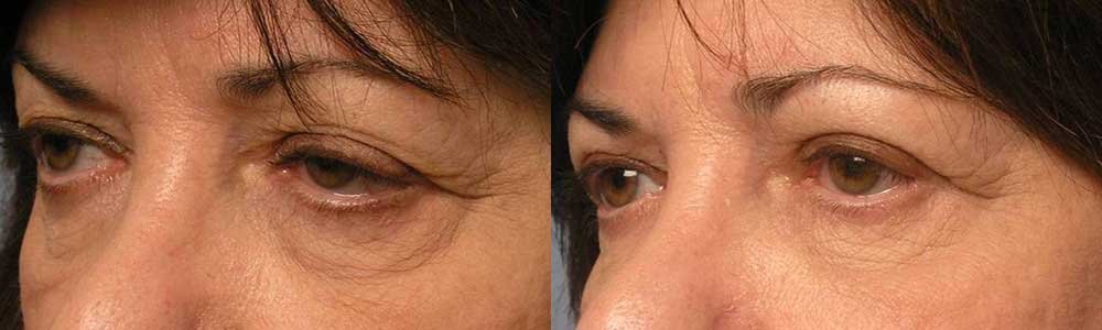 Eyelid Corner Slant Treatment in LA