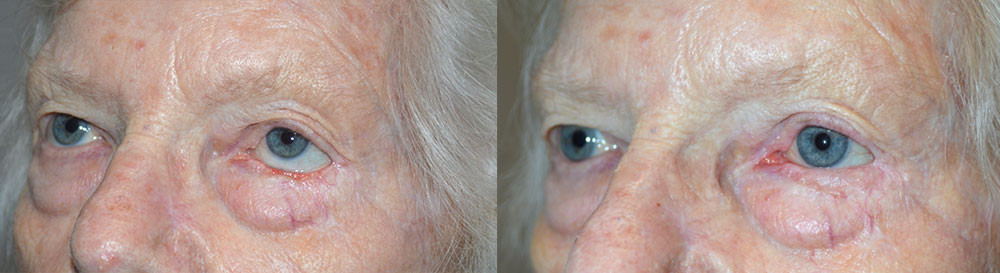 70+ year old female, with left lower eyelid retraction and inability to close her left eye (lagophthalmos) secondary to previous skin cancer surgery. She underwent total left lower eyelid reconstruction (using Hughs flap from the upper eyelid) and eyelid retraction surgery with skin graft. Preop and 3 months postoperative photos are shown.