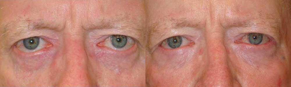 58 year old male, with lower eyelid retraction (secondary to genetics and skin tightening from chronic sun damage), underwent bilateral lower eyelid retraction surgery (with internal hard palate graft, midface lift, and canthoplasty). Before and 3 months postoperative photos are shown.
