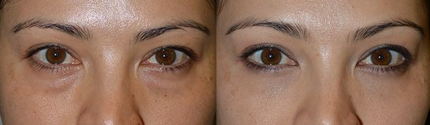 28 year old female, complained of constantly looking tired because of her under eye bags. She has tried to cover it with makeup but not effective. She wanted a long term solution, rather than short-term treatment for hollow under eyes (dark circles) such as filler injection. She underwent cosmetic transconjunctival lower blepharoplasty with fat repositioning (using hidden stitch-less incision inside the lower eyelid, the fat pocket were redistributed to fill the hollow tear trough area) plus conservative skin removal using skin pinch method. The cosmetic eyelid procedure was done under local anesthesia in the office, with quick recovery. Preop and 2 months postoperative photos are shown.
