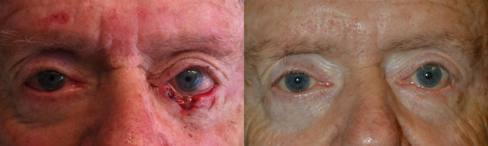 70+ year old male, with large left lower eyelid defect after Mohs procedure to remove eyelid skin cancer (basal cell carcinoma). He underwent left lower eyelid skin cancer reconstruction. Before and 3 months postoperative photos are shown.