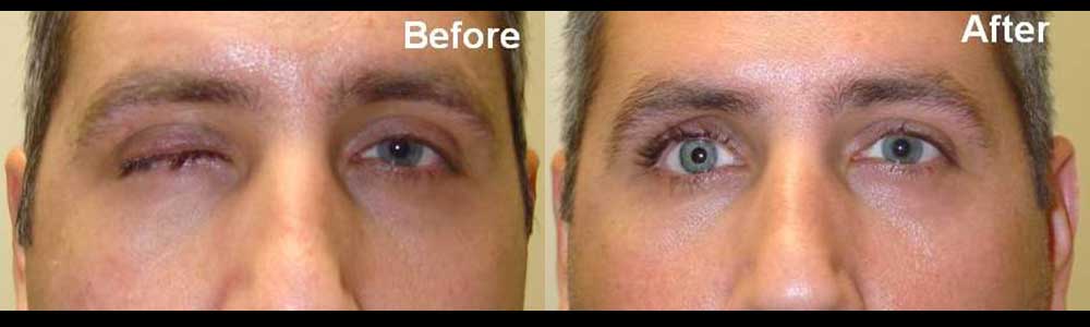 Left photo shows 2 months after right eye evisceration (removal). Right photo shows after prosthesis placement.
