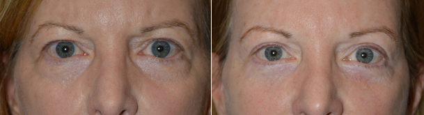 Eyelid Lift Cosmetic Procedure