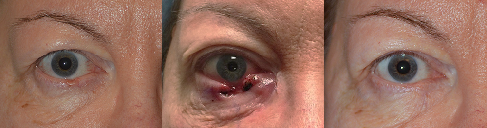 65 year old female, with right lower lid basal cell carcinoma (left photo). Central photo shows immediately after Mohs procedure to remove the eyelid skin cancer. The right photo shows 2 months after right lower eyelid cancer reconstruction using lateral Tenzel flap. Note natural appearing results with minimal hidden scarring, and complete eyelid function.