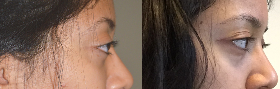 Young girl who has inherited large myopic eyes (giving appearance of protruding bulgy eyes). Note the eyeball is anterior to the brow bone (left photo). She underwent cosmetic orbital decompression (orbit bone and fat removed behind the eyeball) which allowed the large eyeball to sink bank. Note the 3 months postoperative photo (right) shows the eyeballs are now posterior to the brow bone. (In future, she would also benefit from filler or fat injection around eyes to improve the hollowness around eyes.)