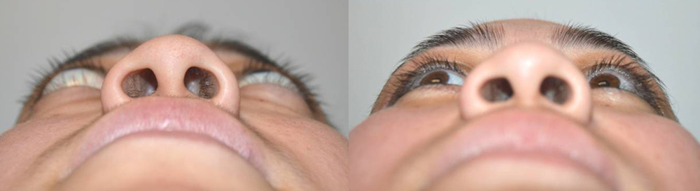 24 year old female, was unhappy with severe bulging eyes and lower eyelid retraction (pulled down) from Grave’s disease, with significant change in eye and facial appearance. She also suffered from lagophthalmos (unable to fully close her eyes) with dry eyes. She underwent bilateral orbital decompression surgery (eye socket bone and fat removed from behind the eyeball to push back the eyeball) and lower eyelid retraction surgery (to raise the lower eyelids). Note improved eye appearance and function (eye is able to close now). Before and 2 months postoperative photos are shown.