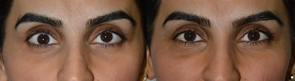 Right eye sunken eye (enophthalmos) surgery: 40 year old female, with sunken right eye (enophthalmos) from previous trauma. Note the right eyeball is deeper (termed enophthalmos) and lower than the normal left eyeball (termed hypoglobus). She underwent reconstructive surgery with right orbital implants, which enabled the right eyeball to be brought back into more normal position. Before (left) and 3 months postoperative (right) photos are shown. Note more normal symmetric eyes after surgery. (She would also benefit from filler injection on both eyes.)