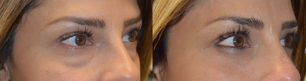 37 year old female, complained of under eye bags and dark circles and looking tired. She underwent cosmetic lower blepharoplasty, using transconjunctival approach with fat repositioning, meaning the existing fat/bags were repositioned to fill the hollow area below them (dark circles), giving more youthful, rested eye appearance, without changing the eye shape or causing sunken eyes.
