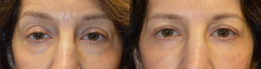55 year old female, complained of looking tired and older. She underwent cosmetic eyelid procedures including lower blepharoplasty (transconjunctival with fat repositioning) to correct under eye bags, upper blepharoplasty (skin only), and upper eyelid ptosis (droopy eyelid; eyelid lift) surgery. Before and 3 months after photos are shown, with natural results.