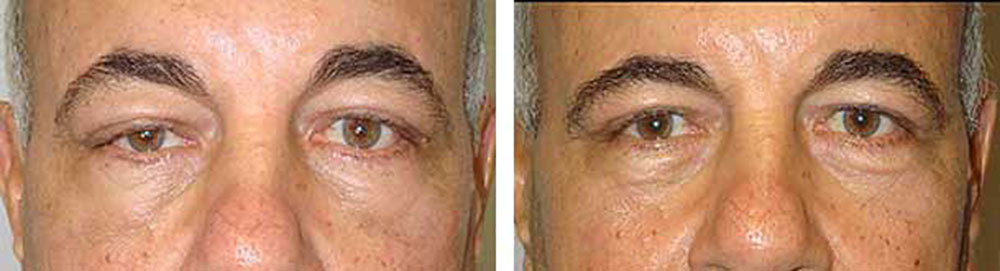 Fixing Failed Prior Ptosis Procedures in LA