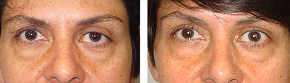 Revisional Ptosis Treatment by Los Angeles Surgeon