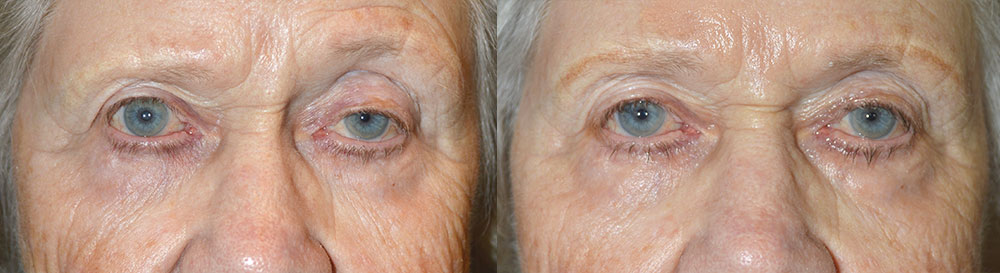 Revisional Ptosis by Los Angeles Oculoplastic Specialist