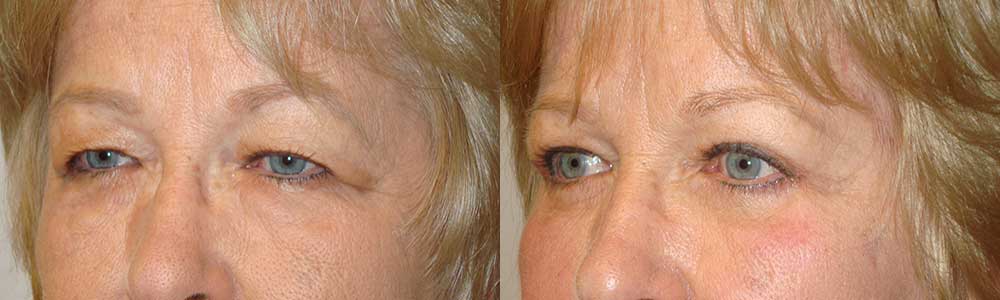 Eye Bags Removal Surgery Procedure