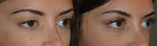 Patient with History of Prior Ptosis Surgery in LA