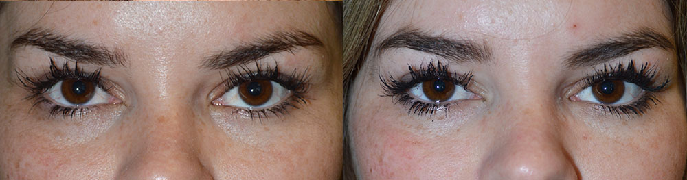 Secondary Eyelid Procedure in Los Angeles