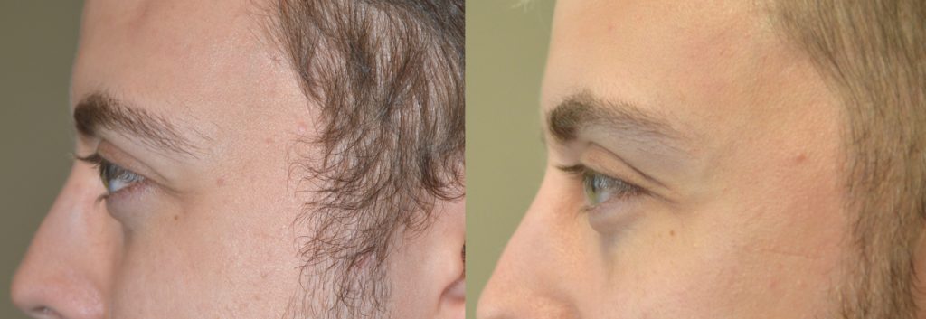 Young man, insecure about congenital bulgy eyes, underwent cosmetic orbital decompression. Preop (left) and postop (right) photos are shown. You can listen to his video testimonial on the our website testimonial page.