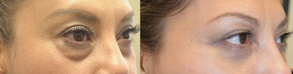 39 year old female, complained under eye bags and dark circles, looking tired. She underwent transconjunctival lower blepharoplasty with fat redraping and skin pinch excision, to improve both the eye bags and dark circles (latter due to hollowness from tear trough deformity). Before and 2 months after cosmetic lower eyelid surgery photos are shown.