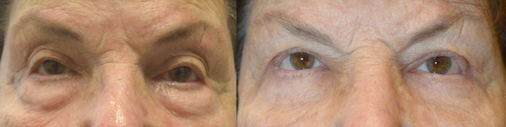 83 year old female, with upper eyelid ptosis with abnormal eyelid contour after failed upper eyelid ptosis surgery and blepharoplasty, underwent revision upper eyelid ptosis surgery using full-thickness method, where mainly the medial upper eyelids (segment closer to the nose) were lifted. She also had unrelated lower blepharoplasty (tranconjunctival with fat repositioning and skin pinch) for under eye bags. Before and 3 months after eyelid surgery photos are shown.