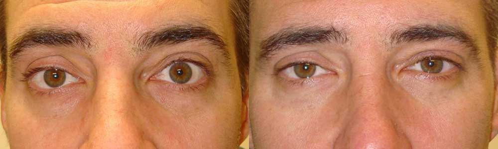 Young man, complained of eye shape/size asymmetry with left eye bigger, which is secondary to left upper eyelid retraction (eyelid too high). He underwent left upper eyelid retraction surgery (to lower the left upper eyelid), under local anesthesia. Before (left) and 3 months after (right) photos are shown. Note improve eye appearance and symmetry.