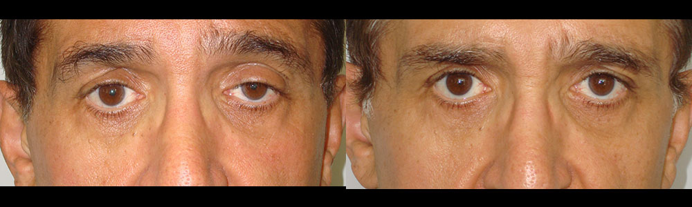 Before After of Upper Eyelid Revision