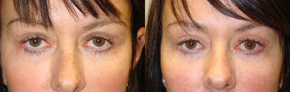 Cat Eye Treatment by Los Angeles Oculoplastic Surgeon