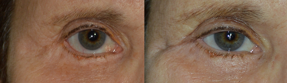 Middle age woman, with right lower eyelid retraction secondary to previous transcutaneous lower blepharoplasty (post-blepharoplasty eyelid retraction), now needing revision cosmetic eyelid correction. She underwent revision eyelid surgery to include right lower eyelid retraction repair (internal approach, with Alloderm graft, midface lift) and canthoplasty, giving more natural almond shape eye appearance. Before and 3 months postoperative photos are shown. (later she would also benefit from droopy upper eyelid surgery and eyebrow lift)