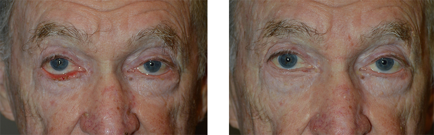 70 year old male, with right lower eyelid cicatricial ectropion (secondary to previous skin cancer surgery pulling the eyelid down), underwent right lower eyelid ectropion repair with skin graft. Note the lower eyelid is repositioned to nicely hug the eyeball with eyelashes in proper position, with natural result.