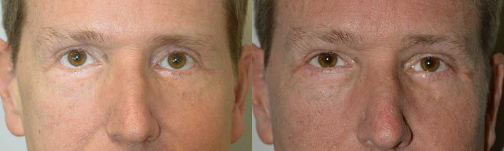Middle age man, was unhappy about with lower eyelid retraction resulting from previous lower transcutaneous blepharoplasty (post-blepharoplasty eyelid retraction), with sclera show (white showing under eyes). He underwent reconstructive lower eyelid retraction repair (with internal Alloderm graft, midface lift, and canthoplasty) to raise the lower eyelids to more proper level. Note improved eyelid position and more attractive almond shape eye in the 3 months postoperative photo.