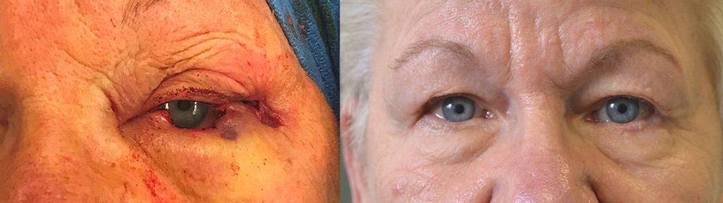 79 year old female, with left lower eyelid basal cell carcinoma, s/p MOHs surgical removal, underwent left eyelid reconstruction. Before and 3 months after eyelid skin cancer surgery photos are shown.