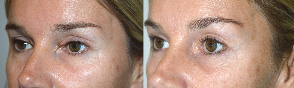 canthus from previous blepharoplasty with canthal web. She underwent revision eyelid scar surgery with epicanthoplasty. Preoperative and 3 months postoperative photos are shown.
