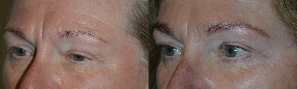 Youthful Eyebrow Surgery