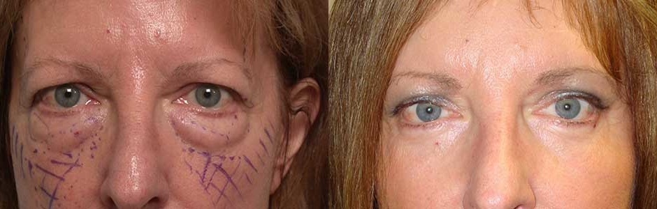 Forehead Lift Oculoplastic Surgeon