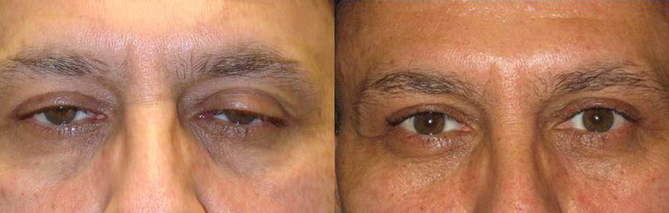Middle age man, complained of tired eye appearance, which is secondary to upper eyelid ptosis. He underwent cosmetic upper eyelid ptosis surgery (internal approach), under local anesthesia in the office. Before and 3 months postoperative photos are shown.