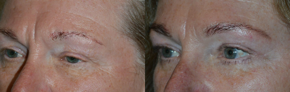 60+ year old female, complained of saggy droopy upper eyelids (secondary to eyelid ptosis and excess skin and lateral brow descent) and under eye wrinkles, underwent cosmetic eye plastic surgery including upper eyelid ptosis surgery (droopy eyelid surgery to raise the upper eyelids), upper blepharoplasty (to address the excess upper eyelid skin), and lower blepharoplasty (transconjunctival with fat repositioning and skin pinch). 3 months postoperative photos after eyelid surgery show the eyes are more open with rested, youthful, natural appearance.