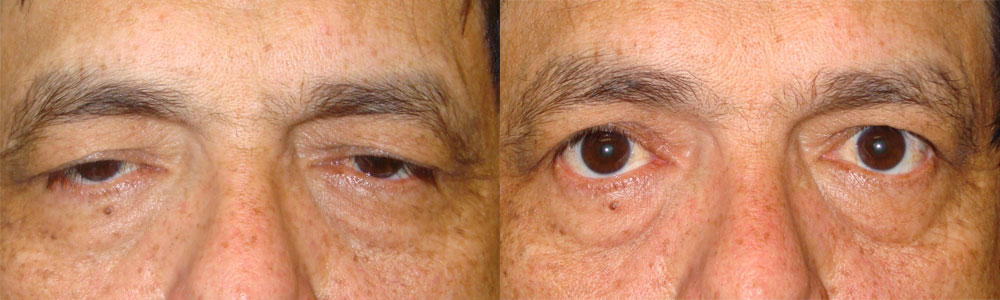 Middle age man, with significant upper eyelid ptosis (droopy upper eyelids through external approach), interfering with his vision, underwent reconstructive bilateral droopy upper eyelid repair and blepharoplasty under local anesthesia. Before and 2 months postoperative photos are shown.