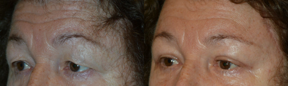 Forehead Lift Treatment in Los Angeles