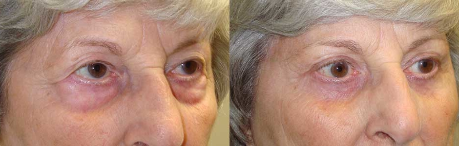 Los Angeles Browlifting Specialist